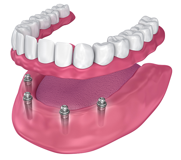 Chesterfield All-on-4 Implants