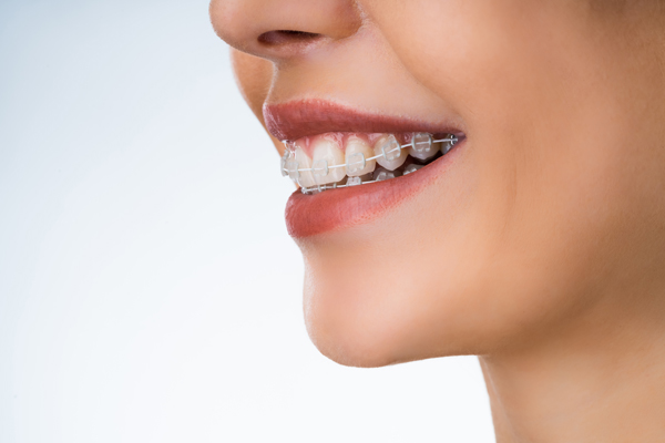 What To Ask Your General Dentist About Clear Braces For Teeth Straightening