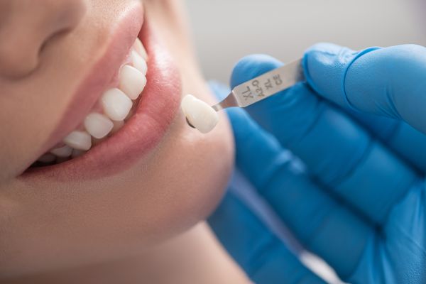 Reasons To Consider Getting Dental Veneers