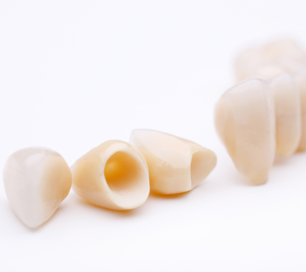 Chesterfield Dental Crowns and Dental Bridges