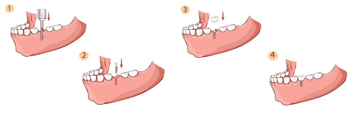 Chesterfield The Dental Implant Procedure