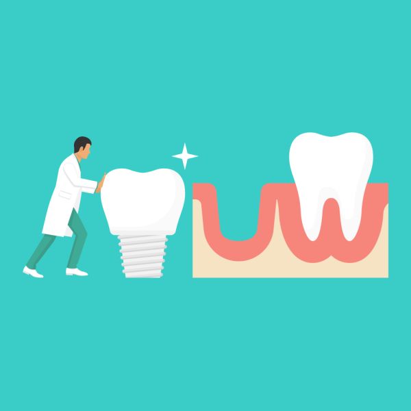 A Guide To Dental Implant Aftercare