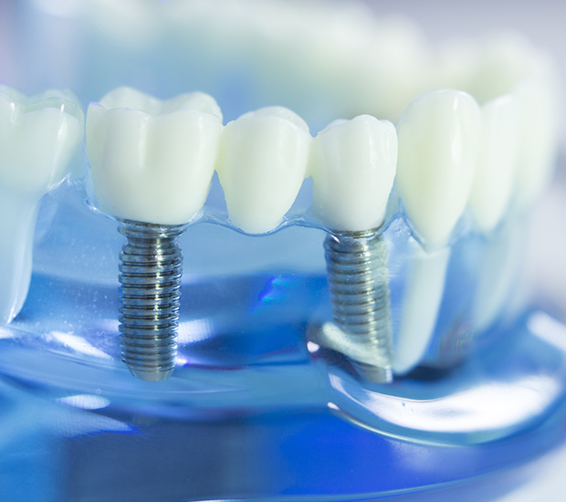 Chesterfield Dental Implants