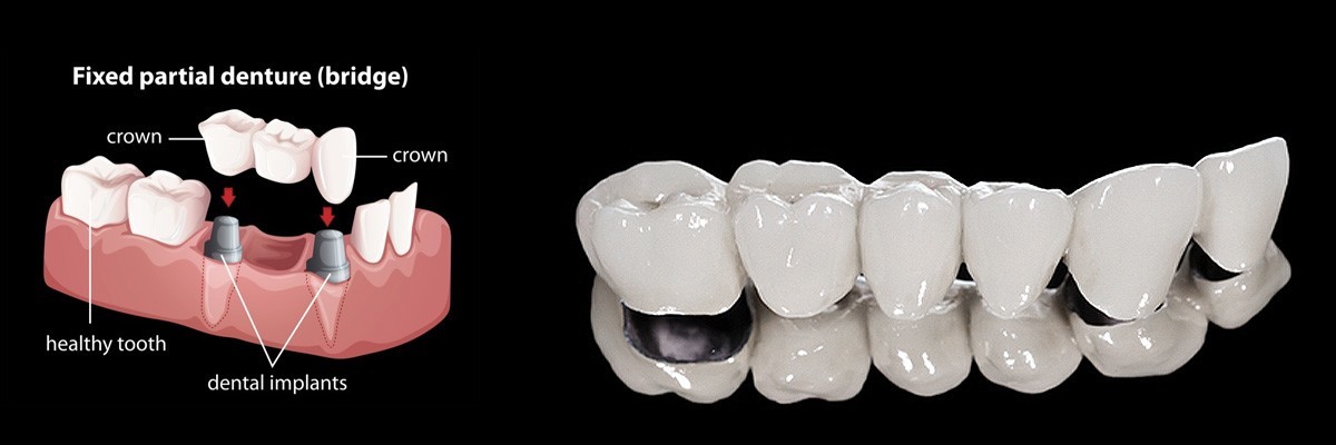 Chesterfield Dentures