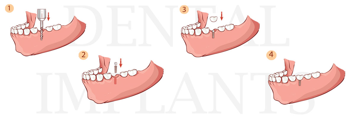 Chesterfield The Difference Between Dental Implants and Mini Dental Implants
