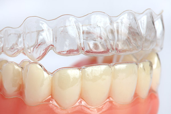 Invisalign® Braces: Facts About The Process