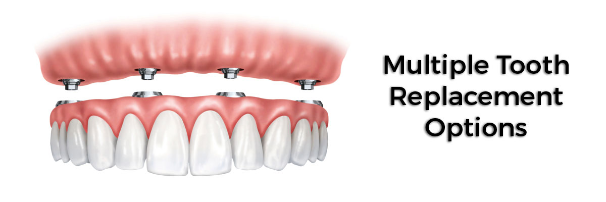 Chesterfield Multiple Teeth Replacement Options