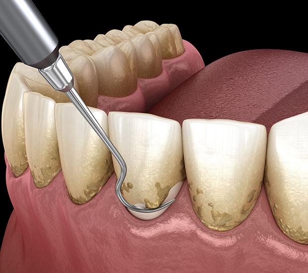 Chesterfield Root Scaling and Planing