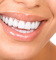 Teeth Whitening Services Chesterfield, MO