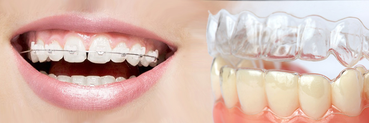 Chesterfield Which is Better Invisalign or Braces