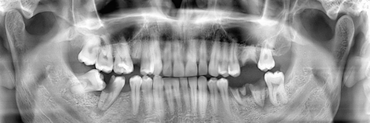 Chesterfield Wisdom Teeth Extraction